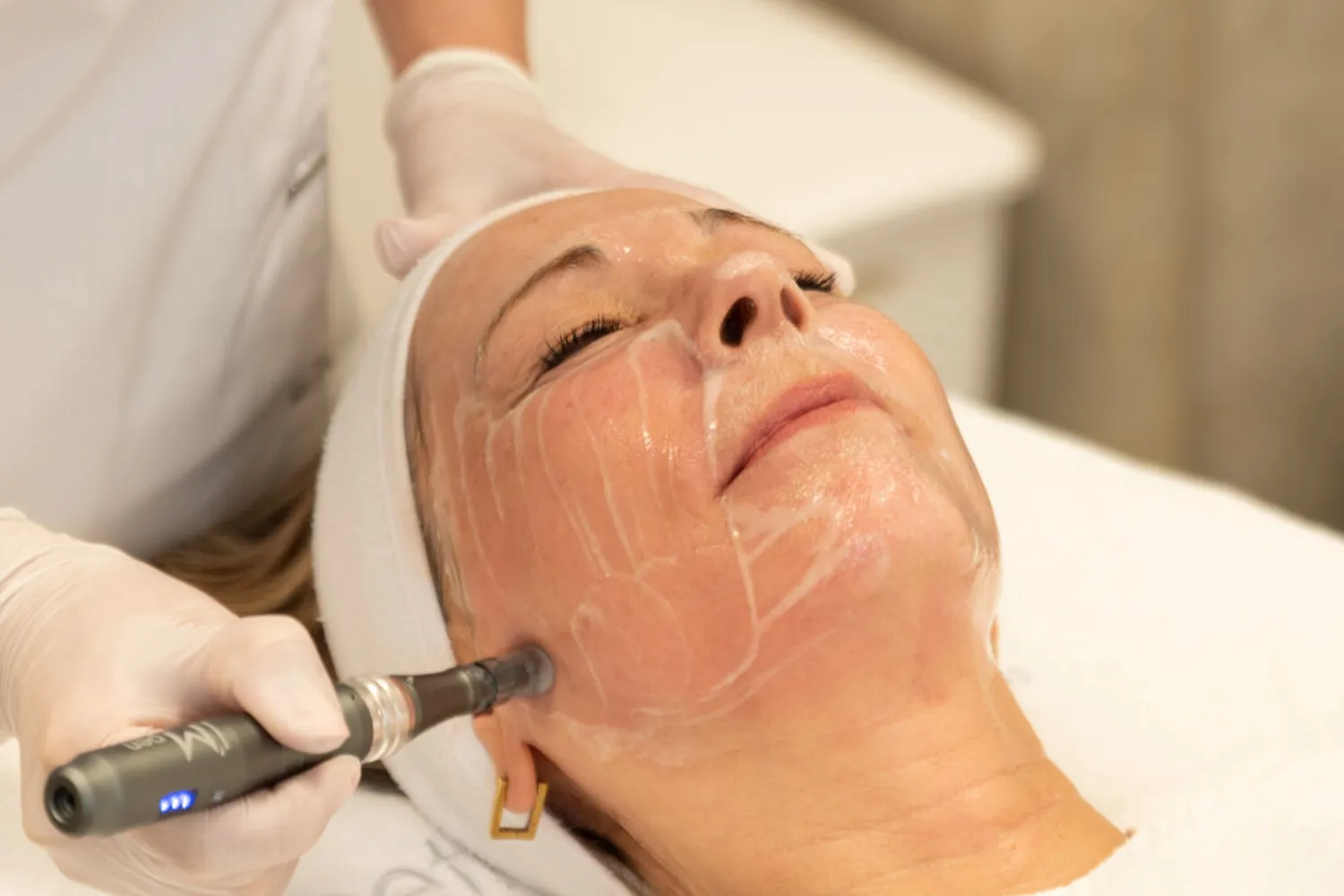 Microneedling & Peeling